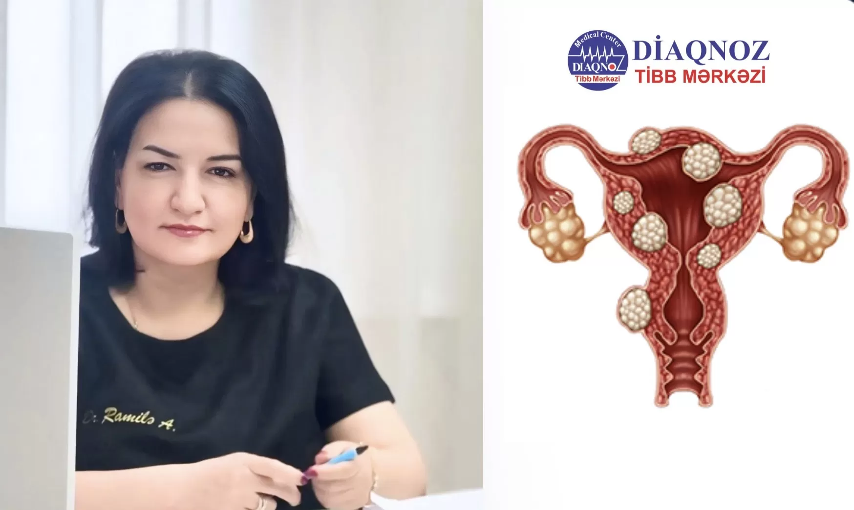 Uşaqlıq mioması təhlükəlidirmi?